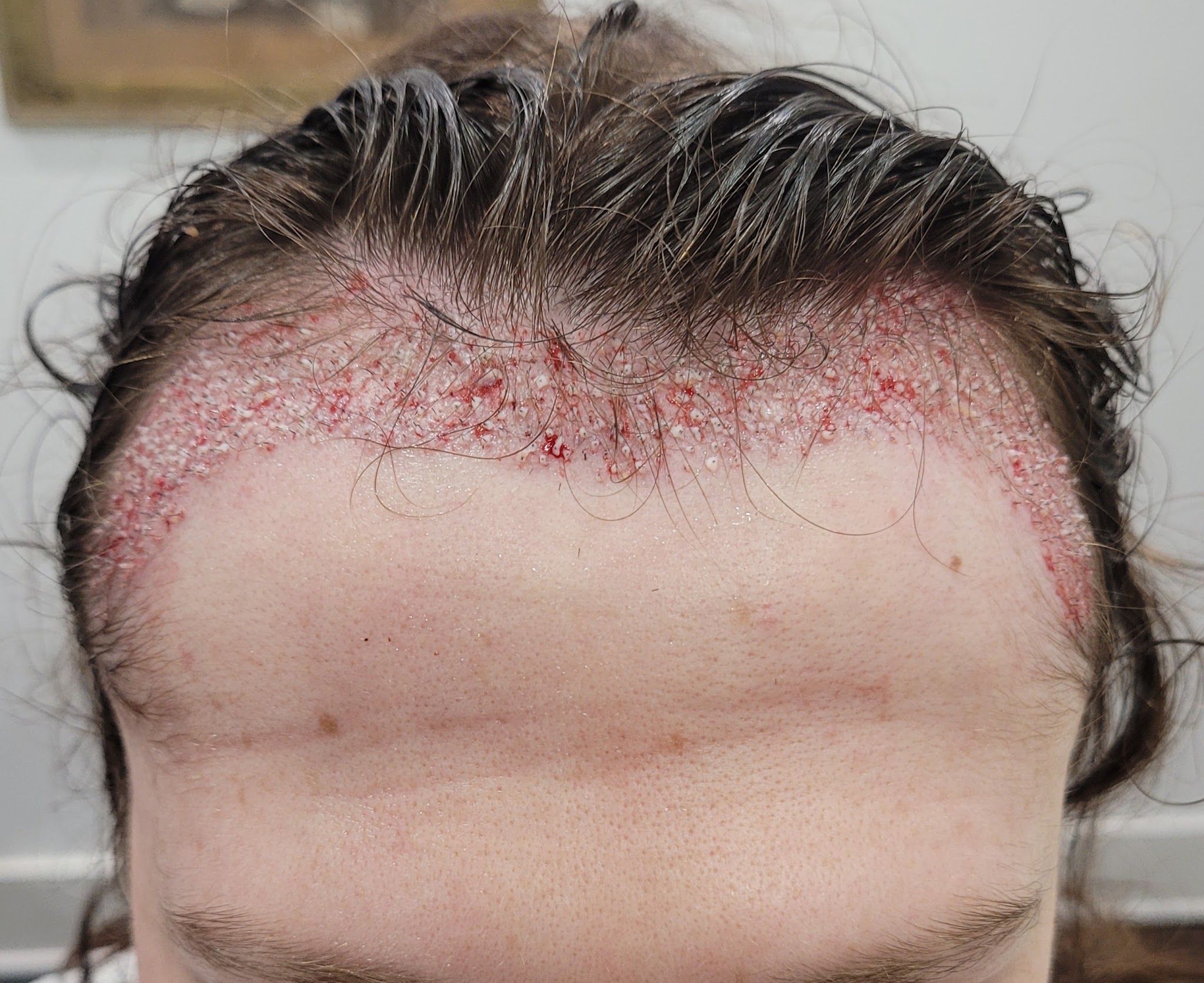Permanent makeup work by Phoenix Hair Restoration & Aesthetics in Duluth, GA