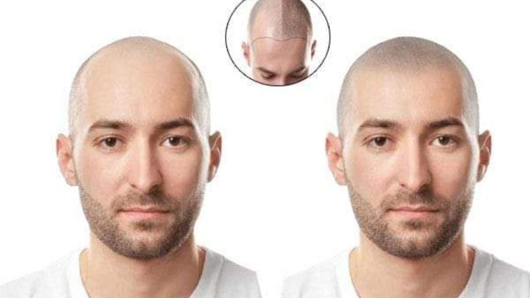 Permanent makeup work by Phoenix Hair Restoration & Aesthetics in Duluth, GA