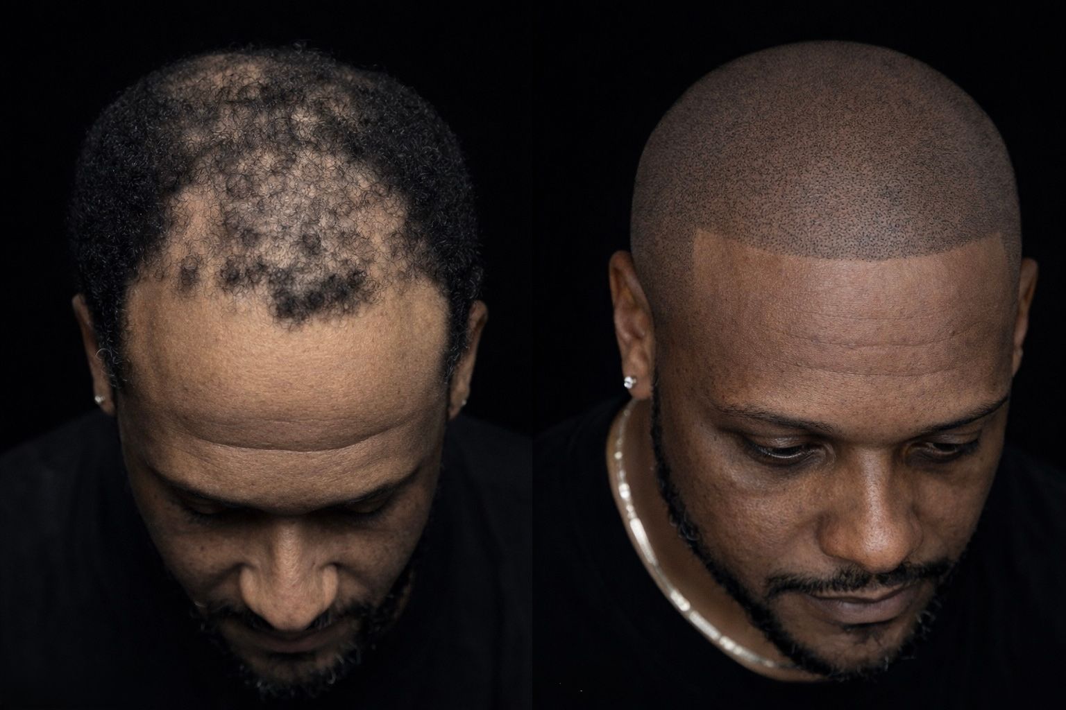 Permanent makeup work by Scalp Micropigmentation By Steven Bradley in Grovetown, GA