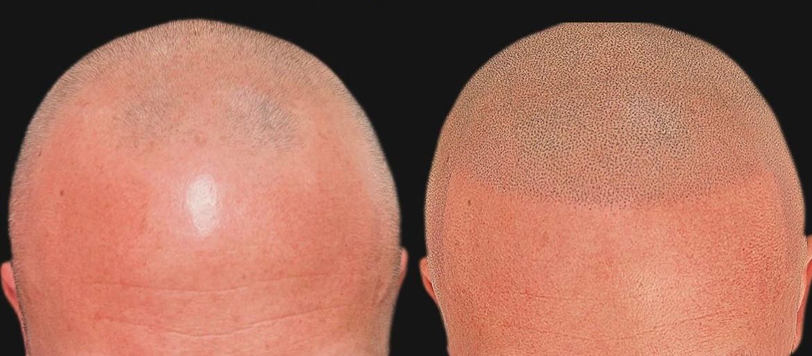 Permanent makeup work by Scalp Micropigmentation By Steven Bradley in Grovetown, GA