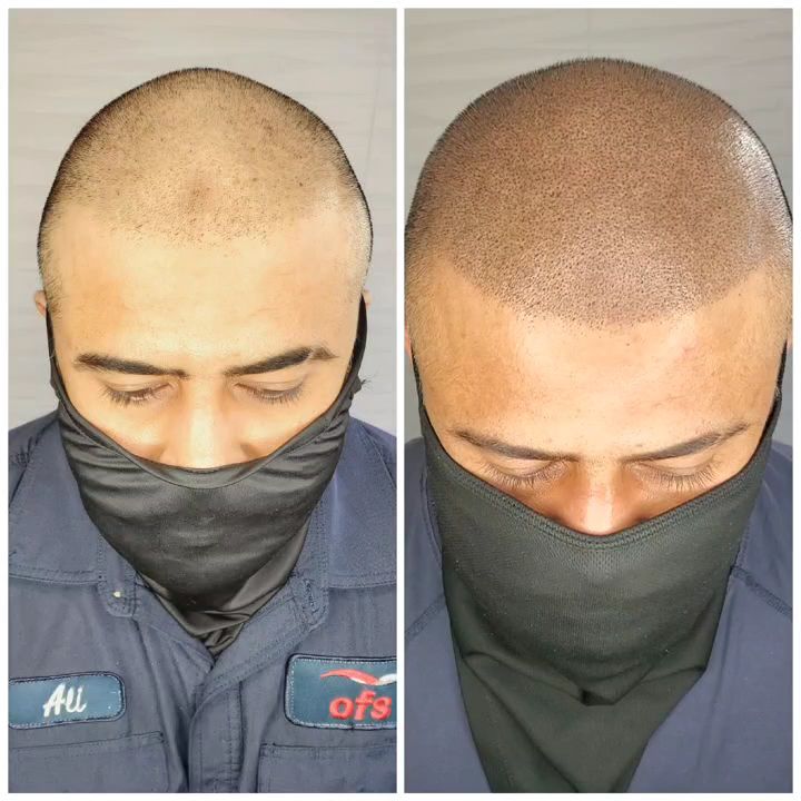 Permanent makeup work by ATL Scalp Micro in Atlanta, GA